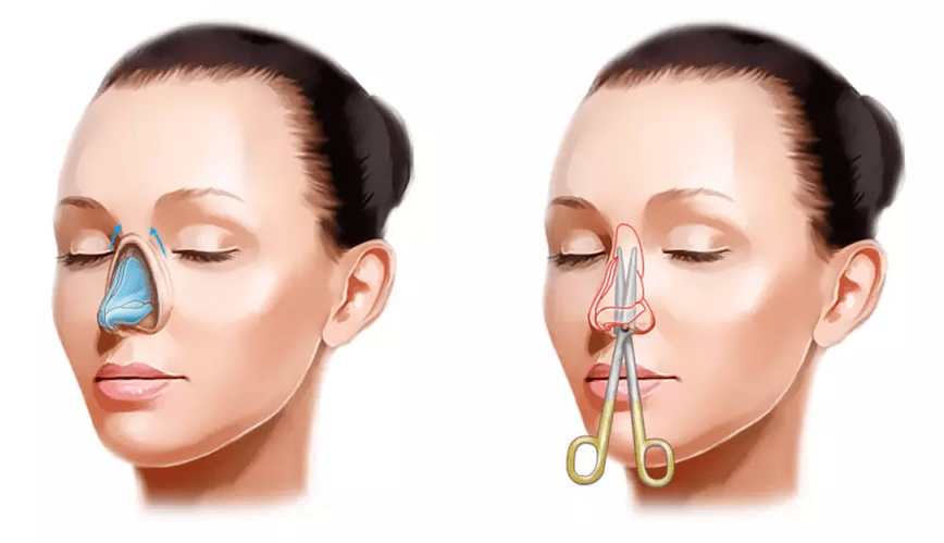 Rhinoplasty