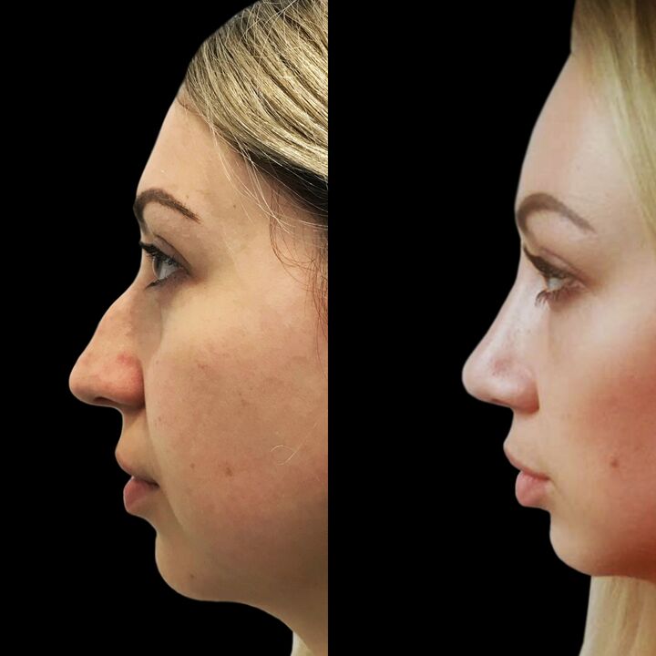 Rhinoplasty