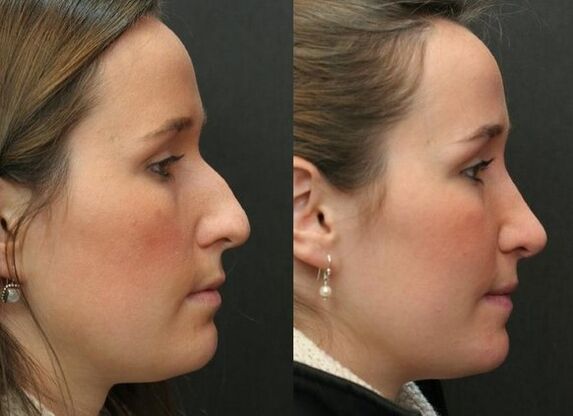 Before and after non -operative rhinoplasty