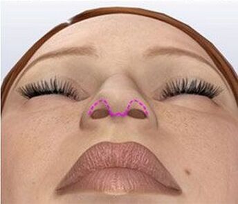 Nasal