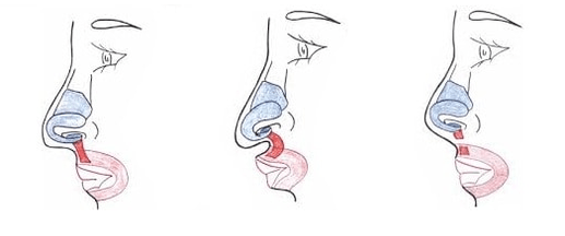 Shortening of part of the nasal muscles