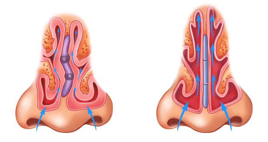 deviation of the nasal septum