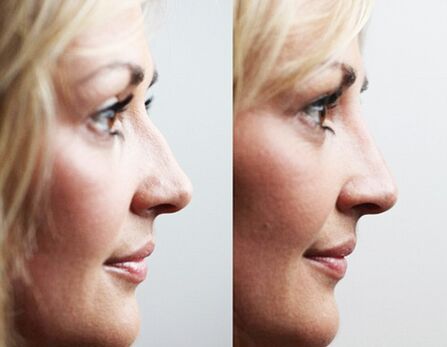 Before and after rhinoplasty with filler