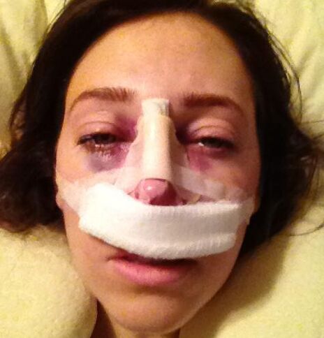 After the operation, a plaster cast is applied to the nose