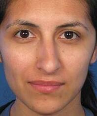 The irregular shape of the nose is a reason for plastic surgery