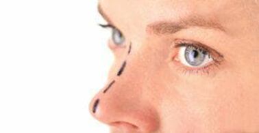The mark on the nose for the insertion of cosmetic threads