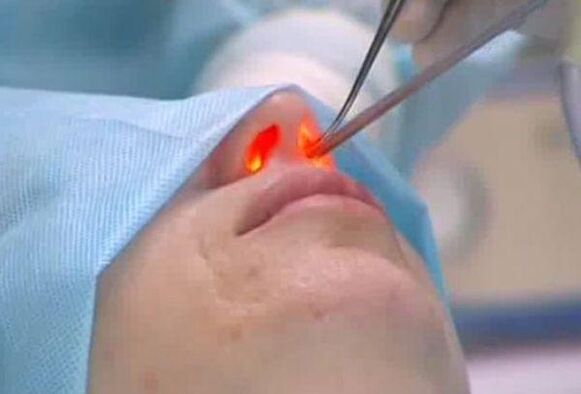 laser nasal rhinoplasty