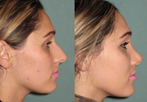 result of rhinoplasty without injection