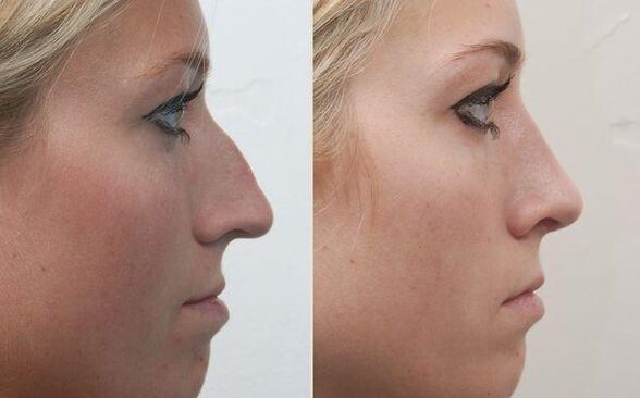 the result of nasal rhinoplasty