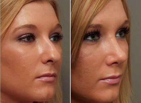 before and after nasal rhinoplasty