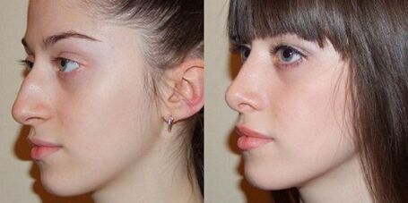 photo before and after nasal rhinoplasty