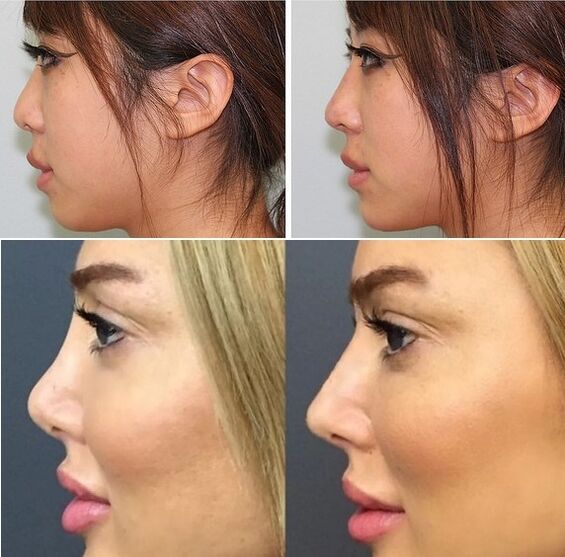 photo before and after non-surgical rhinoplasty