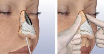 Removal of the nasal tubercle in Israel