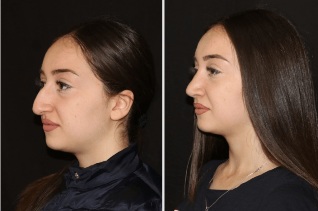 The result of the straighten the nose after rhinoplasty