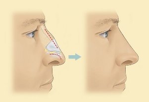 As it is to save on rhinoplasty